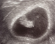 J.D. kidney bean